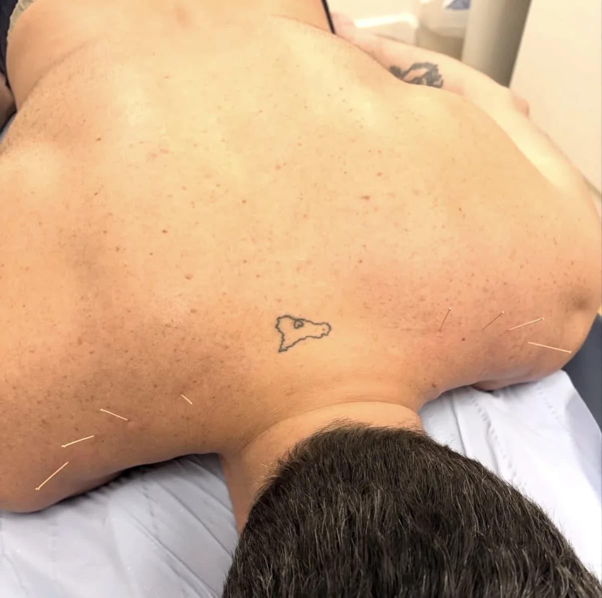 Acupuncture needles in place across a patient's upper back and shoulders at Atlas Osteopathy.