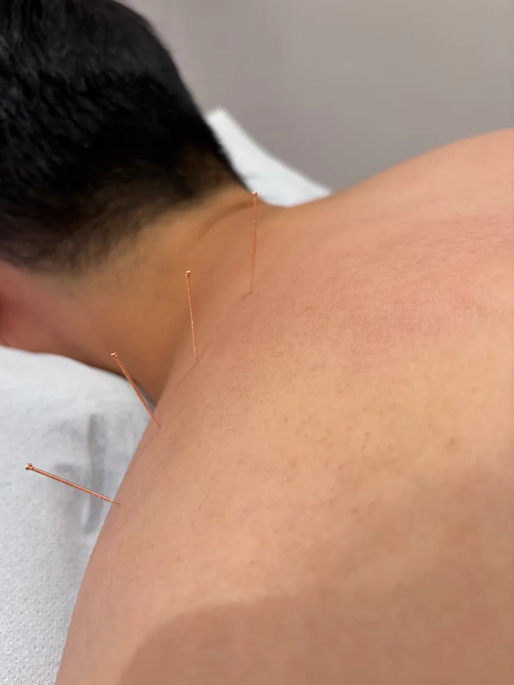 Acupuncture needles placed along a patient's neck and upper shoulder at Atlas Osteopathy.