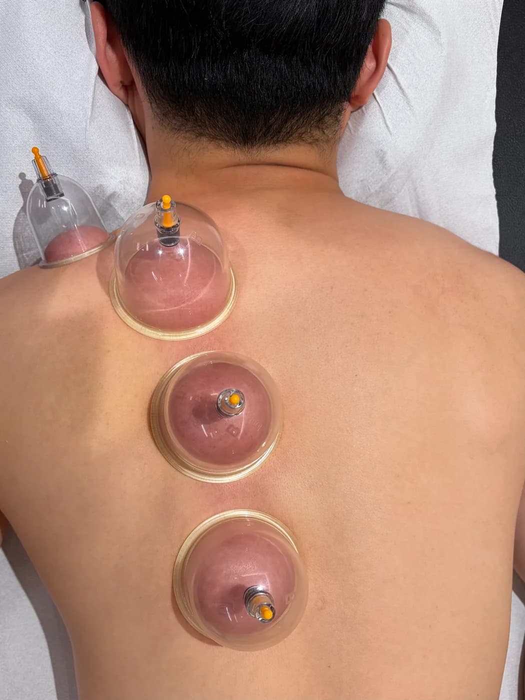 A row of cups placed down a patient's spine during a cupping session at Atlas Osteopathy.