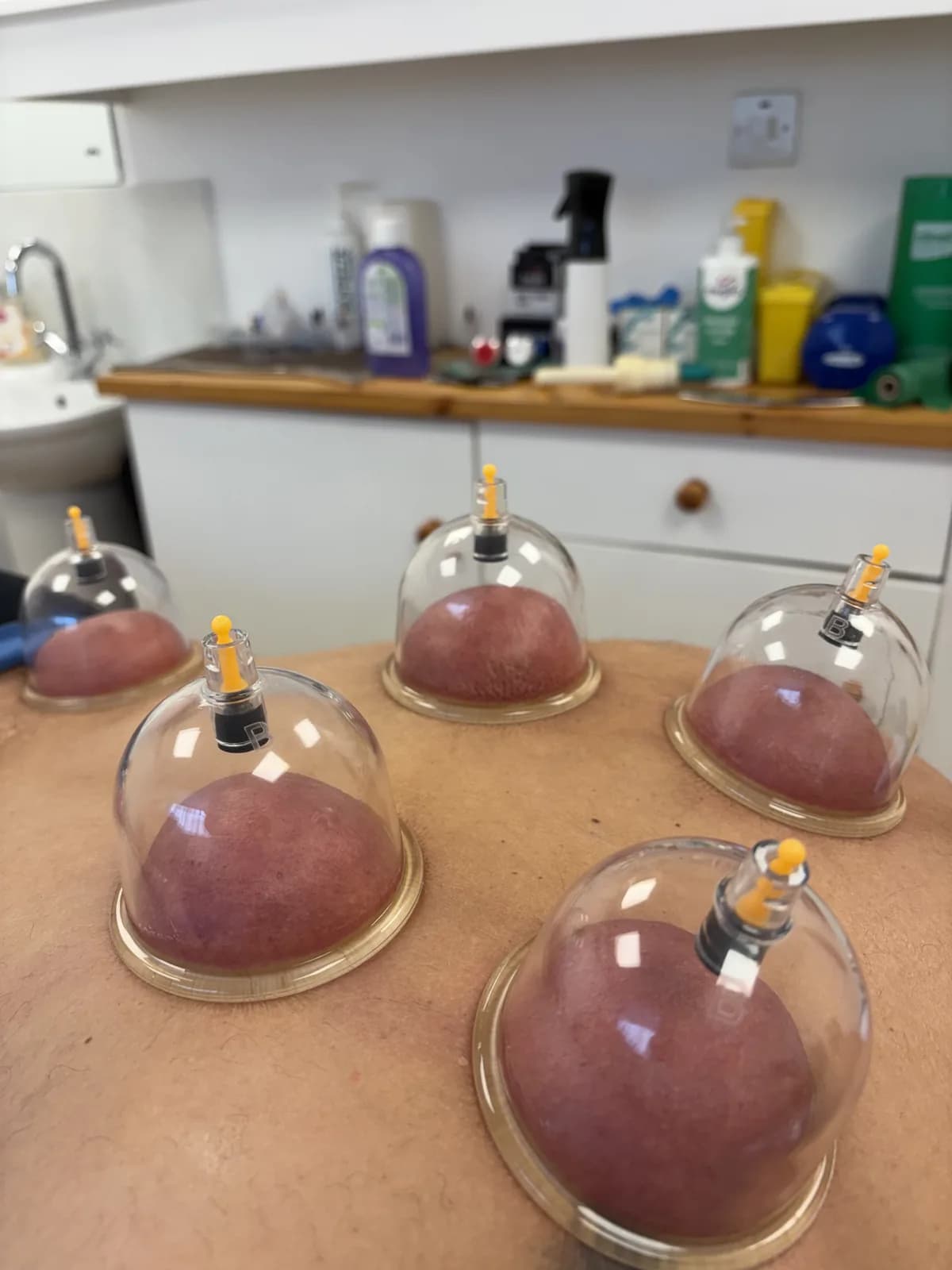 Cupping Therapy
